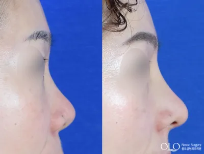 Before & After
