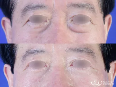Before & After