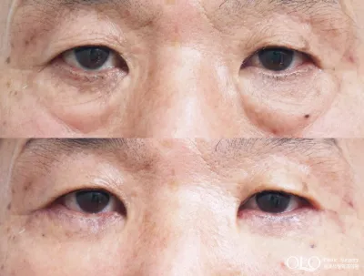 Before & After