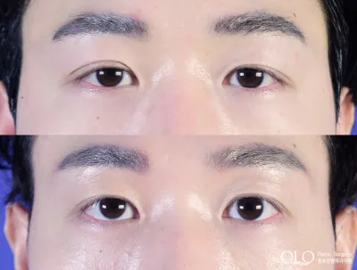 Before & After