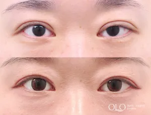 Before
