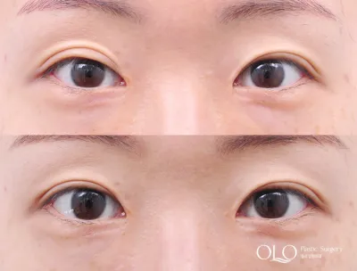 Before & After