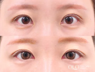 Before & After
