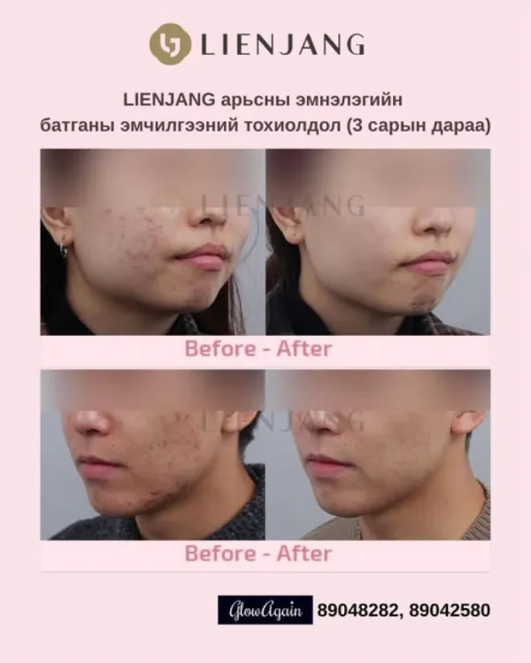 Батганы эмчилгээ , Lienjang арьсны эмнэлэг