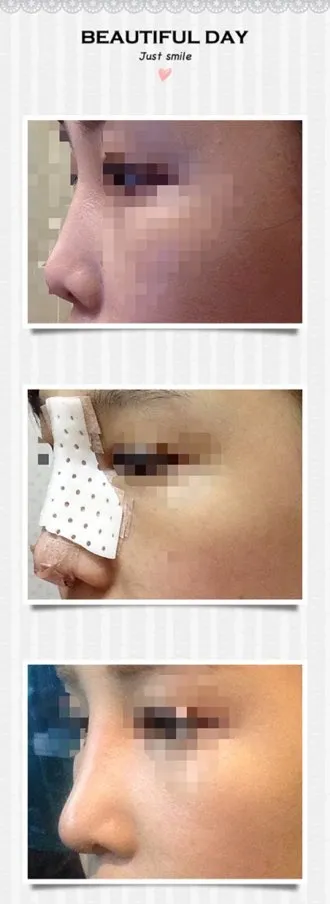 鼻の手術をしてから10日目!!!