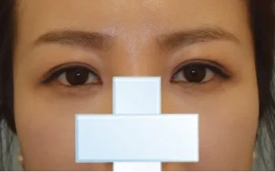 二重が何度も取れてしまうので、悩んだ末に