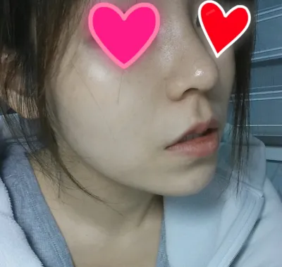 こんにちは。鼻の手術をして1週間ちょっと経ちましたが、とても自然に仕上がったので自慢しに来ました
