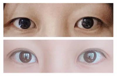 二重手術3ヶ月後のレビュー