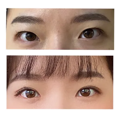 二重埋没＋目頭切開 2ヶ月後のレビューです！