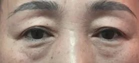 眉下切開と下眼瞼の手術レビュー