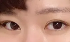 念願の二重整形レポ📝 ママありがとう😭💖 江南ソヨンでアイプチ卒業しました✨