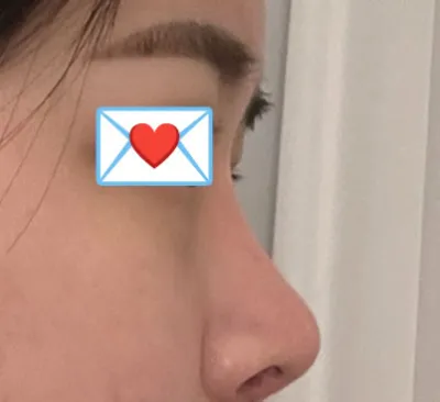 ベリーグッド美容外科のイム・ヨンミン院長に鼻の再手術を受けました！