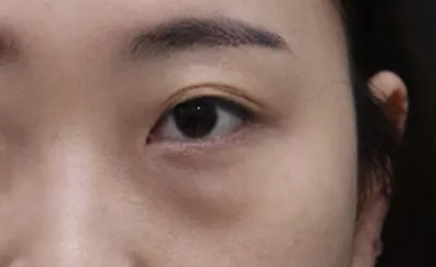 再手術なのでより慎重にあちこちカウンセリングに回りましたが、チェ・ヒョンジョン室長とキム・ヨンウ院長が丁寧に詳しく説明してくださり、安心させてくださったので、こちらに決めました。