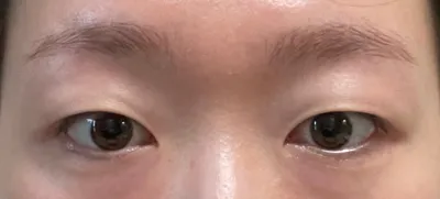 施術前と施術後で印象がかなり変わりましたが、とても満足しています。