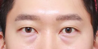 男性の目の下の脂肪再配置のレビューです。