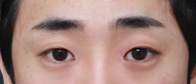 眠そうな目なのと、まつげがずっと目に刺さるので、決心しました。