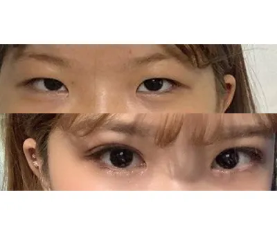 手術にとても満足しています。