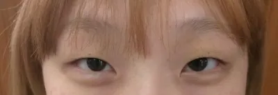 手術してから3ヶ月ほど経ちましたが、腫れがだんだん引いてきて、馴染んできている気がします！！