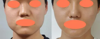 輪郭整形の手術体験談