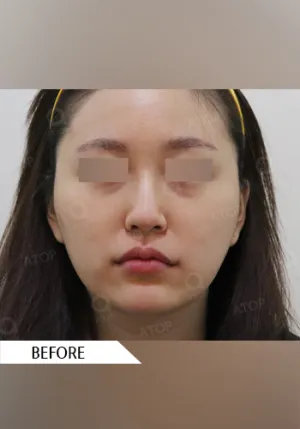 Before