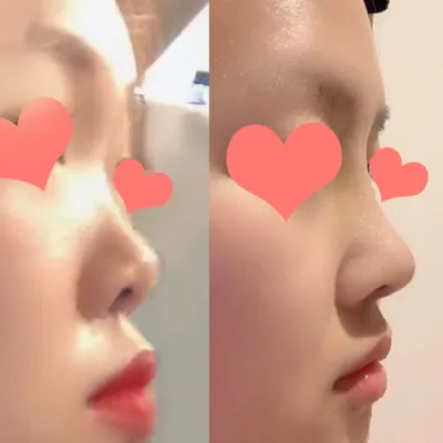 鼻の手術レビュー!!