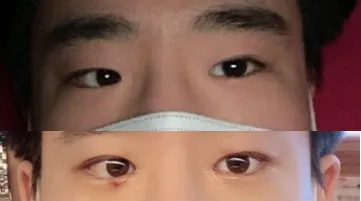 二重（埋没法）、目頭切開