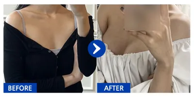 [バビトーク] メンター豊胸整形 1ヶ月目 / ニックネーム：ハンソルソルバラム