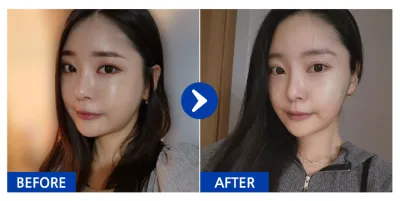 [カンナムオンニ] 顔の脂肪吸引 / 1ヶ月目 / ニックネーム：カムジャモッチン