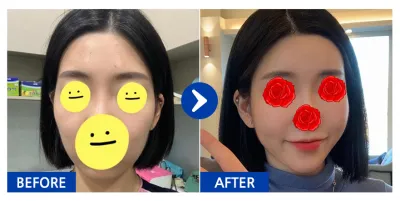 [カンナムオンニ] 脂肪移植 / ニックネーム：テヒヒヒッｗｗ