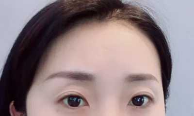 [目] キムジョン キムジョム - 目尻切開、グラマラスライン形成