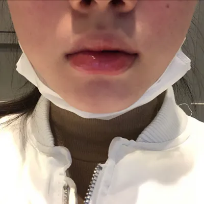 [プチ] キューキャンパンイ - 唇フィラー