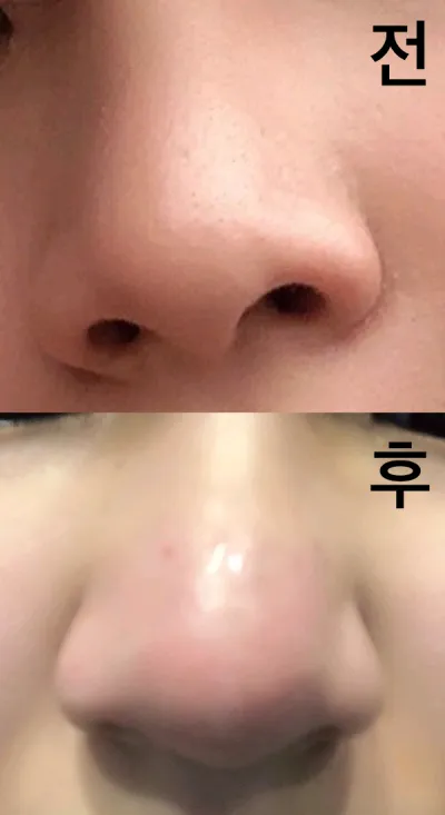 [プチ] 唇 - 鼻の輪郭注射