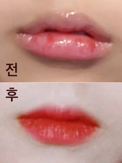 [プチ] 口唇 - フィラー、ボトックス
