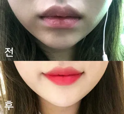 [プチ] コングロンイ - 唇フィラー