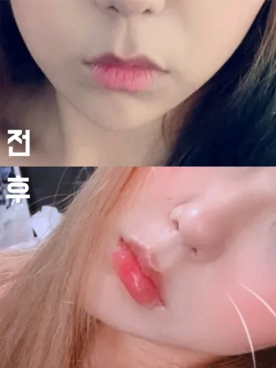 [プチ] チチケ - 唇フィラー