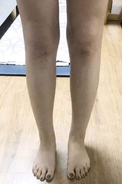 [脂肪吸引] クルタビン - ふくらはぎ、腹部の脂肪吸引