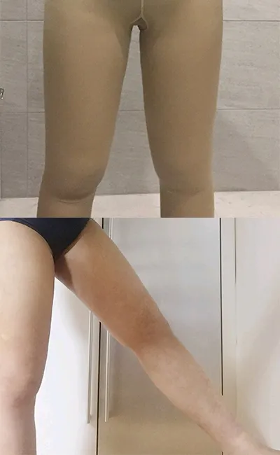 [脂肪吸引]キャーキャー - 脂肪吸引