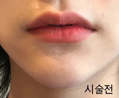 [プチ] ララルリンドン - 唇フィラー