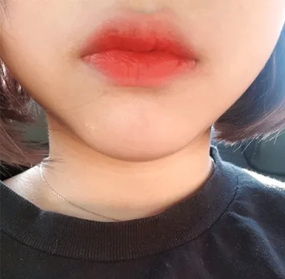 [プチ] awdrgyj - 唇フィラー、ボトックス