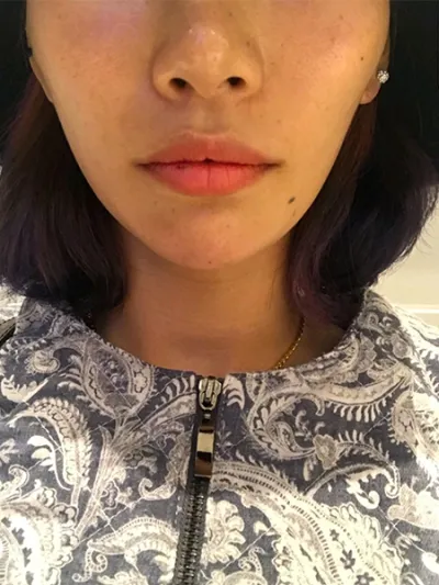 [쁘띠] 化粧する猫 - 唇フィラー、ボトックス