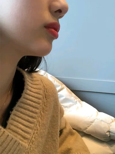 [プチ] fdksk - 顎フィラー