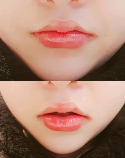 [プチ] キム姫、- 唇フィラー、ボトックス
