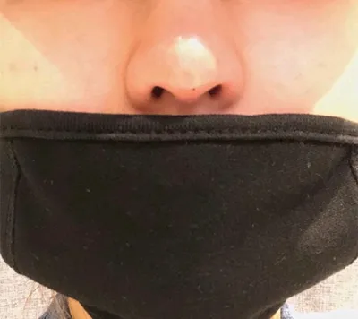 [쁘띠] モモ99 - 鼻の輪郭注射