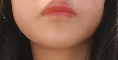 [皮膚] クィダン - レーザーリフティング