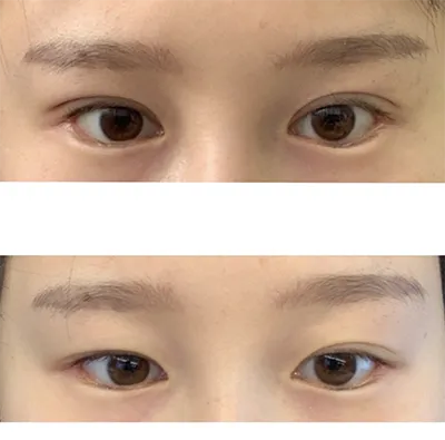 [目] ツナマヨイン - 目