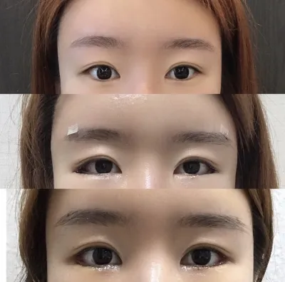 [目] ナナニナン - 目尻切開、グラマラスライン形成