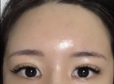 [アンチエイジング] ホ・リョン - 脂肪移植、目