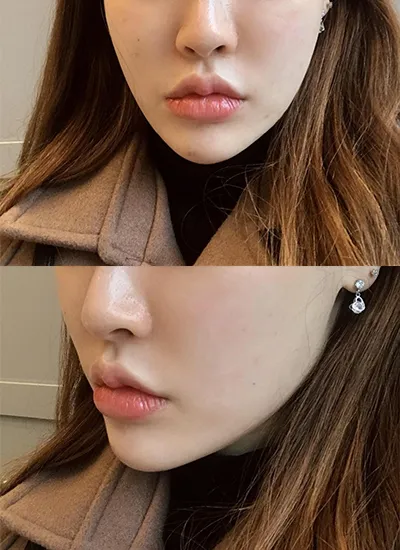 [皮膚] きれいになりたい - シュリンク、輪郭ボトックス