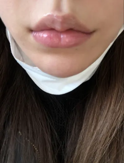 [プチ] vvkim - フィラー