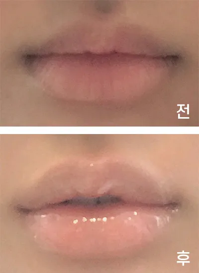 [쁘띠] ㅎリングㅇ - 口角、唇フィラー